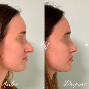 rinoplastia utrasonica mujer perfil crooked nose 1
